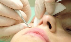 Pastrimi mekanik i fytyrës: rregullat për kryerjen e Përgatitjes për pastrimin mekanik të fytyrës
